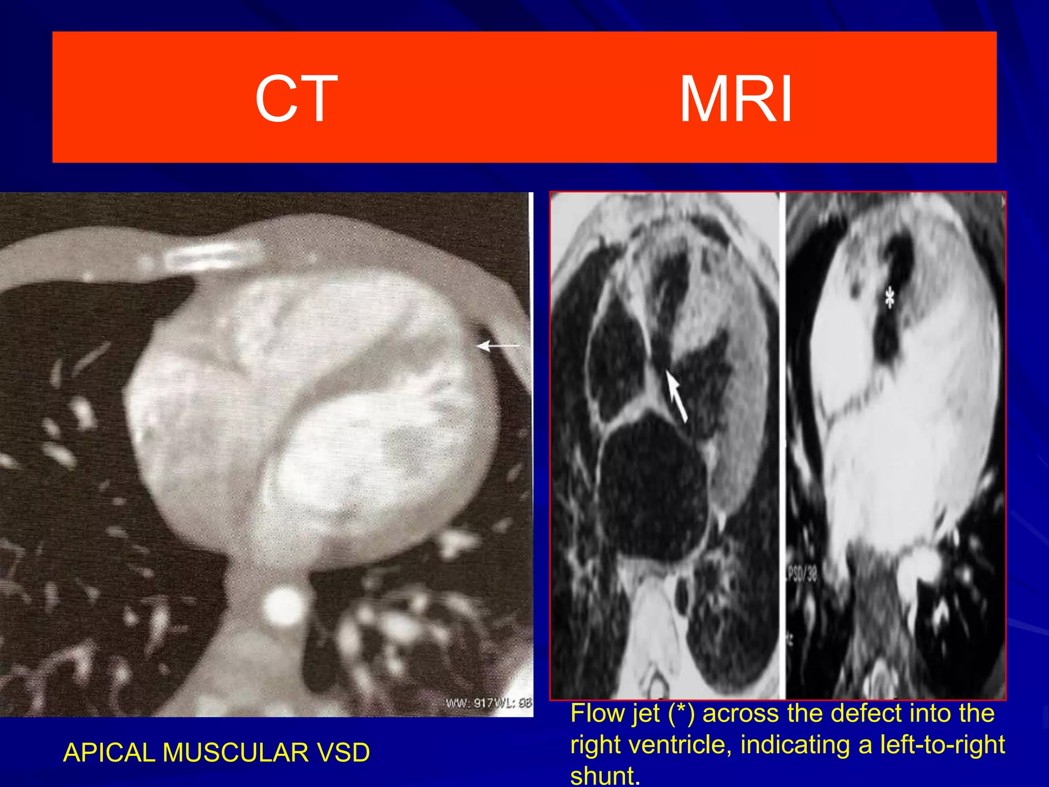 CT

APICAL MUSCULAR VSD

MRI

Flow jet (*) across the defect into the
right ventricle, indicating a left-to-right
shunt.

 