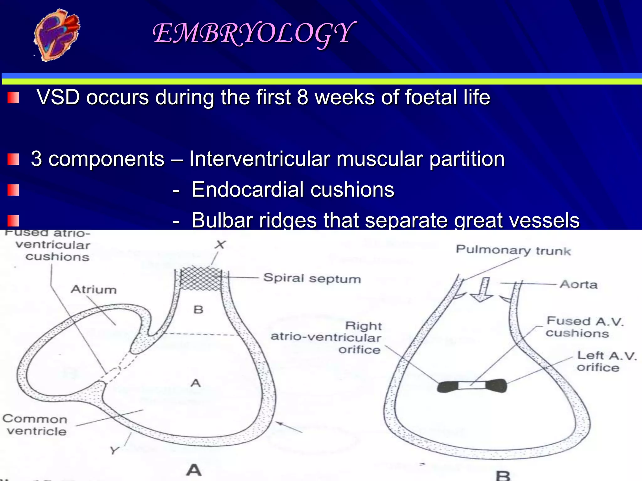 EMBRYOLOGY
VSD occurs during the first 8 weeks of foetal life

3 components – Interventricular muscular partition
- Endocardial cushions
- Bulbar ridges that separate great vessels

.

 