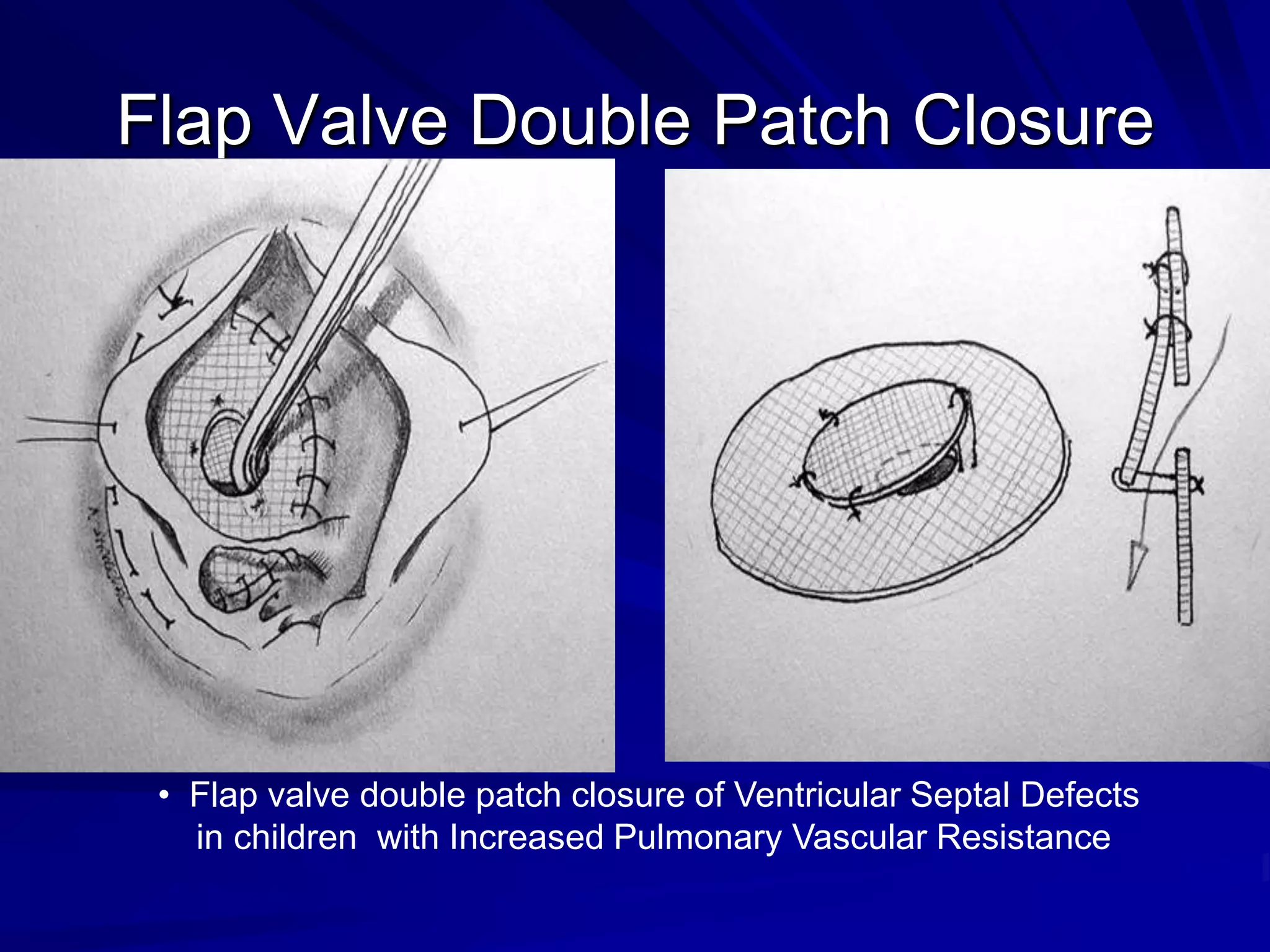 Flap Valve Double Patch Closure

• Flap valve double patch closure of Ventricular Septal Defects
in children with Increased Pulmonary Vascular Resistance

 