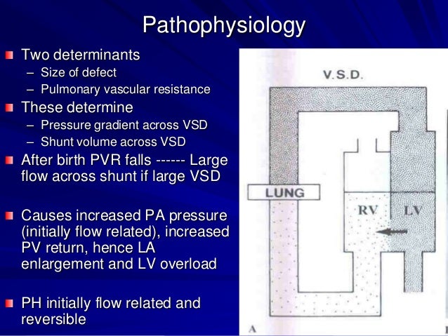 Pathophysiology Of Ventricular Septal Defect In Flow Chart