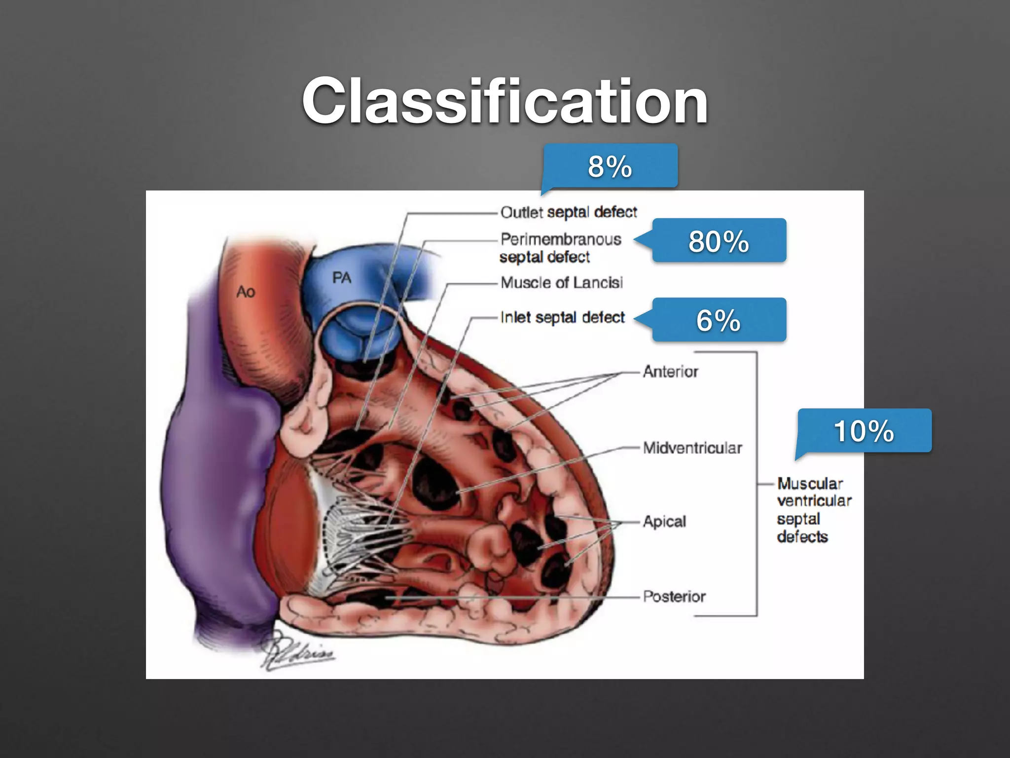 Ventricular septal defect | PDF
