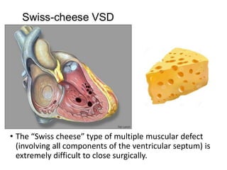 • The “Swiss cheese” type of multiple muscular defect
(involving all components of the ventricular septum) is
extremely difficult to close surgically.
 