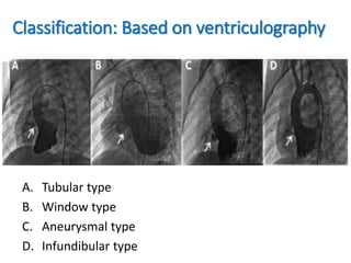 Classification: Based on ventriculography
A. Tubular type
B. Window type
C. Aneurysmal type
D. Infundibular type
 
