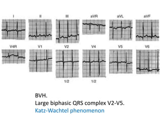 BVH.
Large biphasic QRS complex V2-V5.
Katz-Wachtel phenomenon
 
