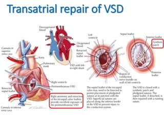 Transatrial repair of VSD
 