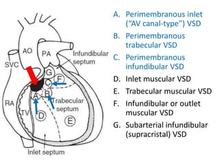 A. Perimembranous inlet
(“AV canal-type”) VSD
B. Perimembranous
trabecular VSD
C. Perimembranous
infundibular VSD
D. Inlet muscular VSD
E. Trabecular muscular VSD
F. Infundibular or outlet
muscular VSD
G. Subarterial infundibular
(supracristal) VSD
 
