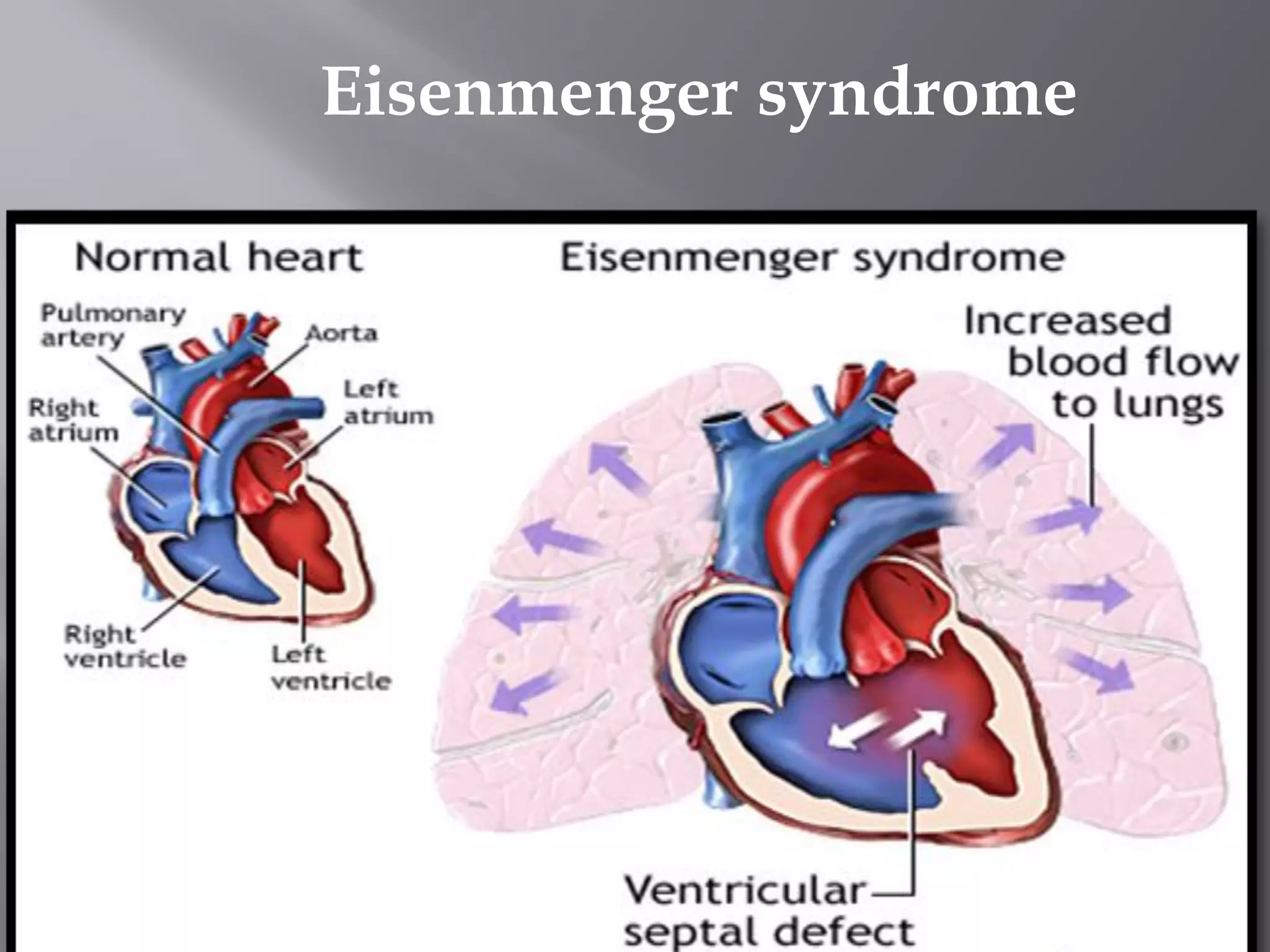 Vsd Management Ventricular Septal Defect with Nursing Management | PDF