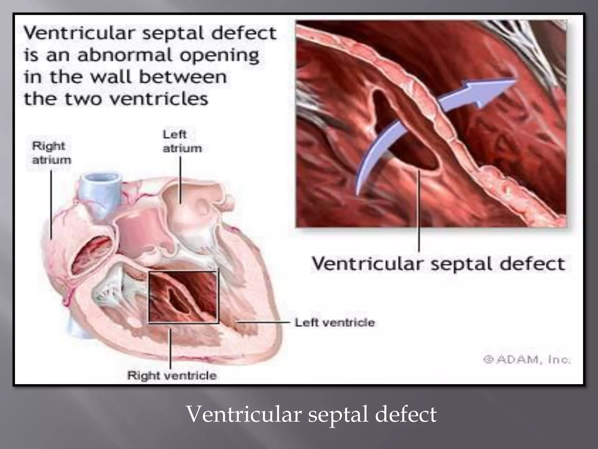 Vsd Management Ventricular Septal Defect with Nursing Management | PDF