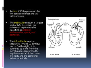 Ventricular Septal Defect | PPTX