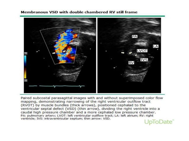 Ventricular Septal defects Echocardiography | PPTX | Heart and ...