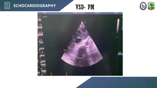 VSD (congenital heart disease explained).pptx