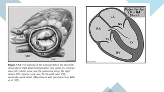 Vsd Management Ventricular Septal Defect (VSD) – Classification, Clinical Features ...