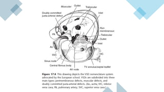 Vsd Management Ventricular Septal Defect (VSD) – Classification, Clinical Features ...
