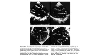 Ventricular Septal Defect (VSD) – Classification, Clinical Features ...