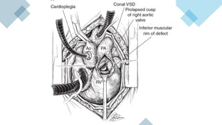 Vsd Management Ventricular Septal Defect (VSD) – Classification, Clinical Features ...