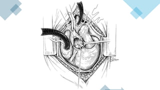 Vsd Management Ventricular Septal Defect (VSD) – Classification, Clinical Features ...