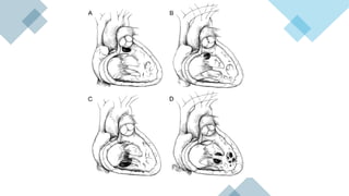 Vsd Management Ventricular Septal Defect (VSD) – Classification, Clinical Features ...