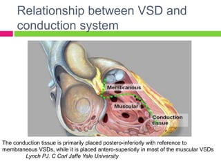 Relationship between VSD and
conduction system
The conduction tissue is primarily placed postero-inferiorly with reference to
membraneous VSDs, while it is placed antero-superiorly in most of the muscular VSDs
Lynch PJ. C Carl Jaffe Yale University
 
