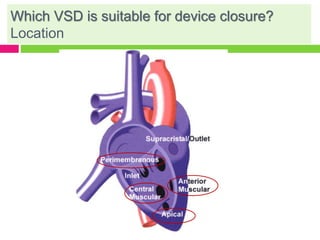 Which VSD is suitable for device closure?
Location
 