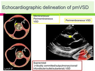 Echocardiographic delineation of pmVSD
Perimembraneous VSD
Supracristal
(=doubly committed/subpulmonary/conal/
infundibular/outlet/subarterial) VSD
Membraneous/
Perimembraneous
VSD
Lynch P
 