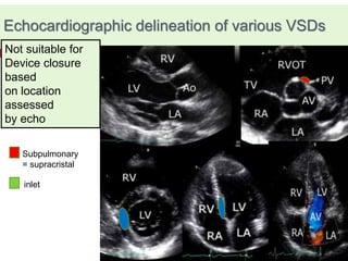 Subpulmonary
= supracristal
inlet
Echocardiographic delineation of various VSDs
Not suitable for
Device closure
based
on location
assessed
by echo
 