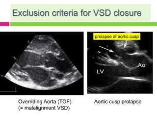 Exclusion criteria for VSD closure
Overriding Aorta (TOF) Aortic cusp prolapse
(= malalignment VSD)
prolapse of aortic cusp
 