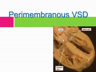 Perimembranous VSD
 