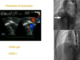 • Presence of aneurysm
• PFM coil
• ADO I
 