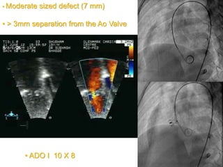 • Moderate sized defect (7 mm)
• > 3mm separation from the Ao Valve
• ADO I 10 X 8
 