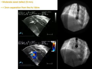 • Moderate sized defect (8 mm)
• < 3mm separation from the Ao Valve
 
