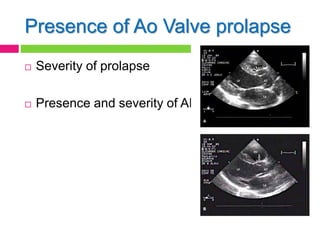 Presence of Ao Valve prolapse
 Severity of prolapse
 Presence and severity of AR
 