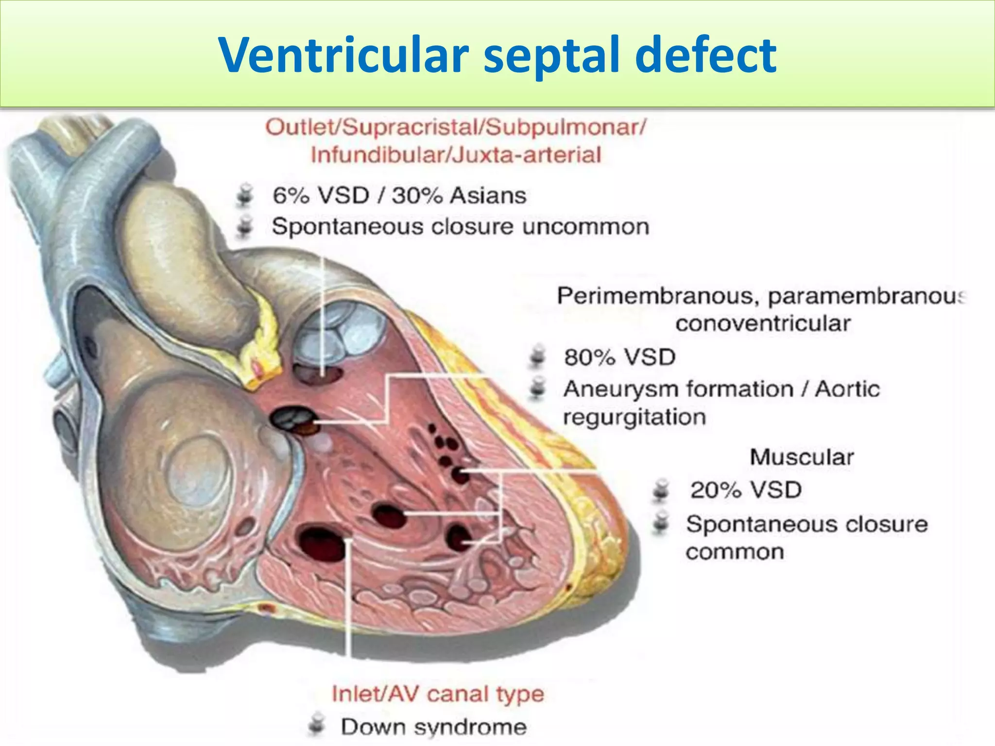 Vsd Management An approach to a patient with ventricular septal defect | PPSX
