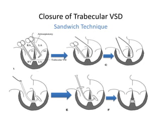 Vsd Explosion MANAGEMENT OF VSD | PPTX
