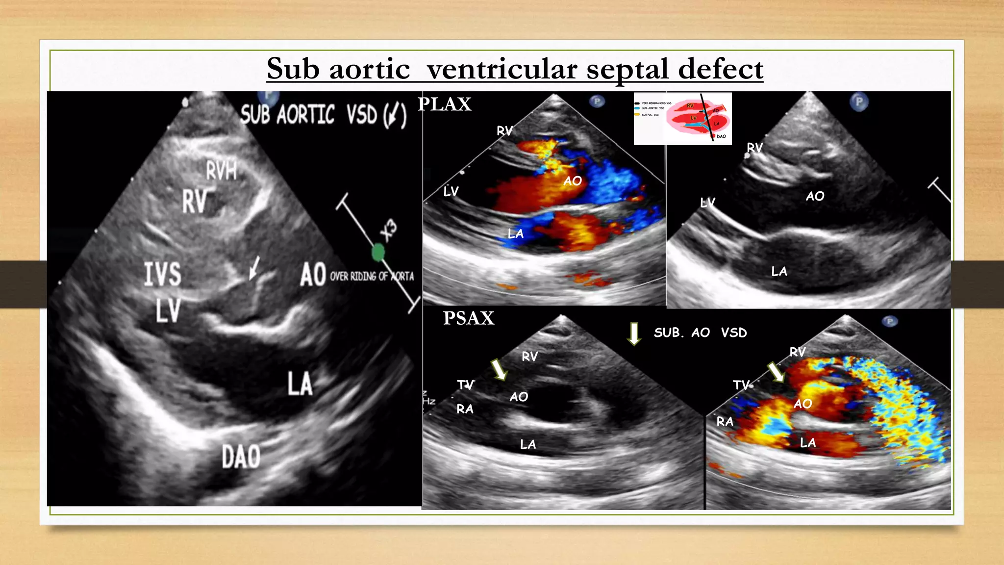 Sub aortic ventricular septal defect
AO
LV
LA
AO
AO
AO
LA
LA
LA
SUB. AO VSD
RA
RV
LV
RV
RV
RV
RA
TV
TV
PSAX
PLAX
 