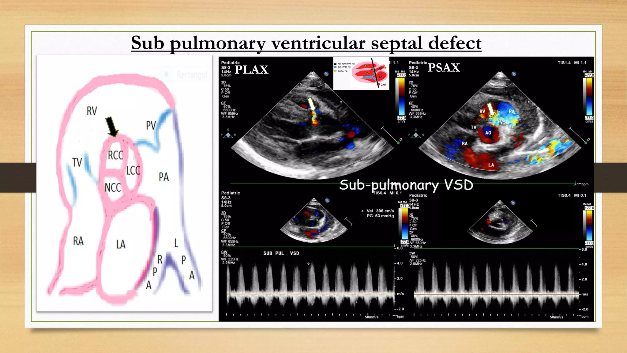 Sub pulmonary ventricular septal defect
PSAX
PLAX
 