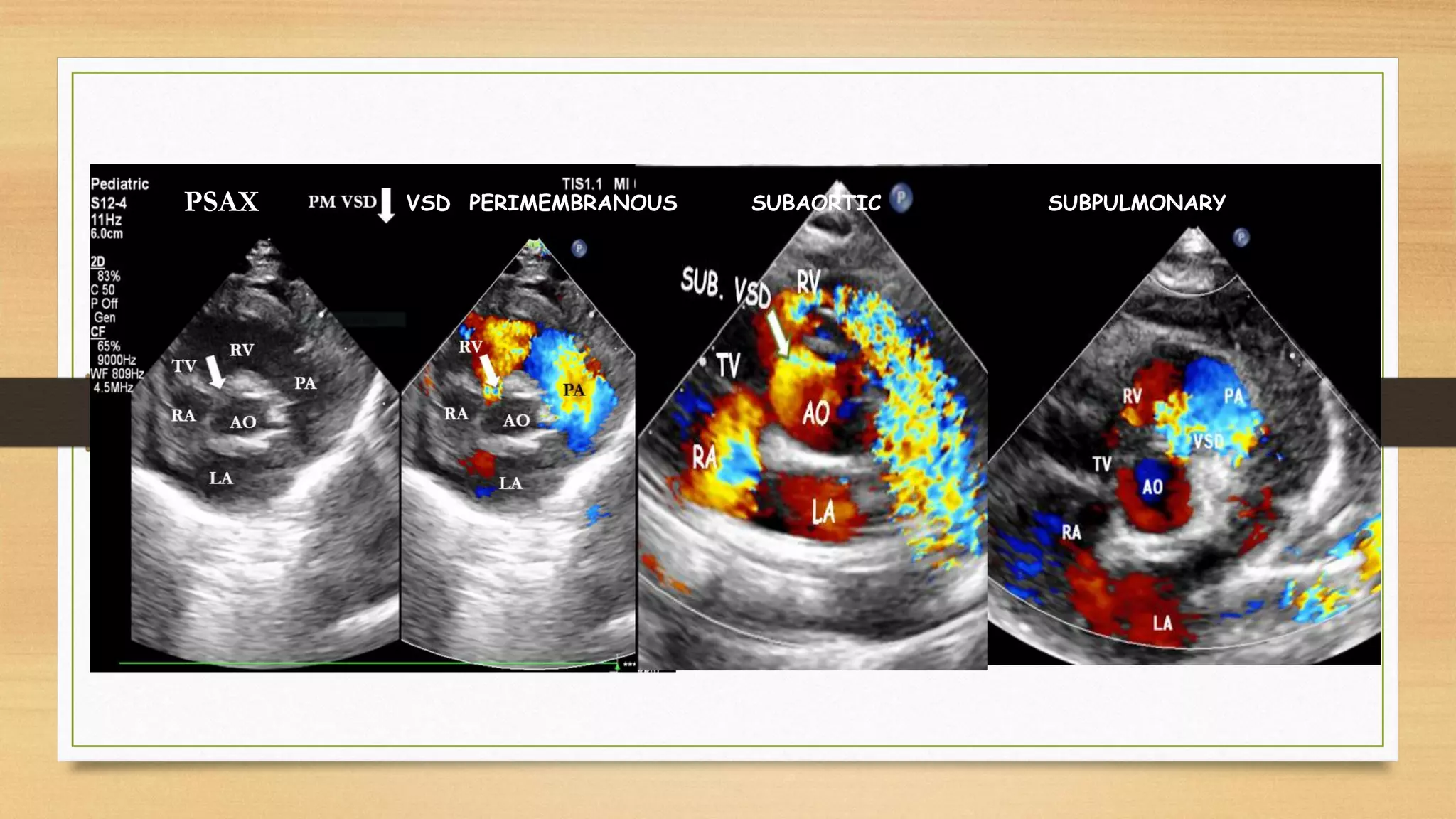 VSD PERIMEMBRANOUS SUBAORTIC SUBPULMONARY
PSAX
 