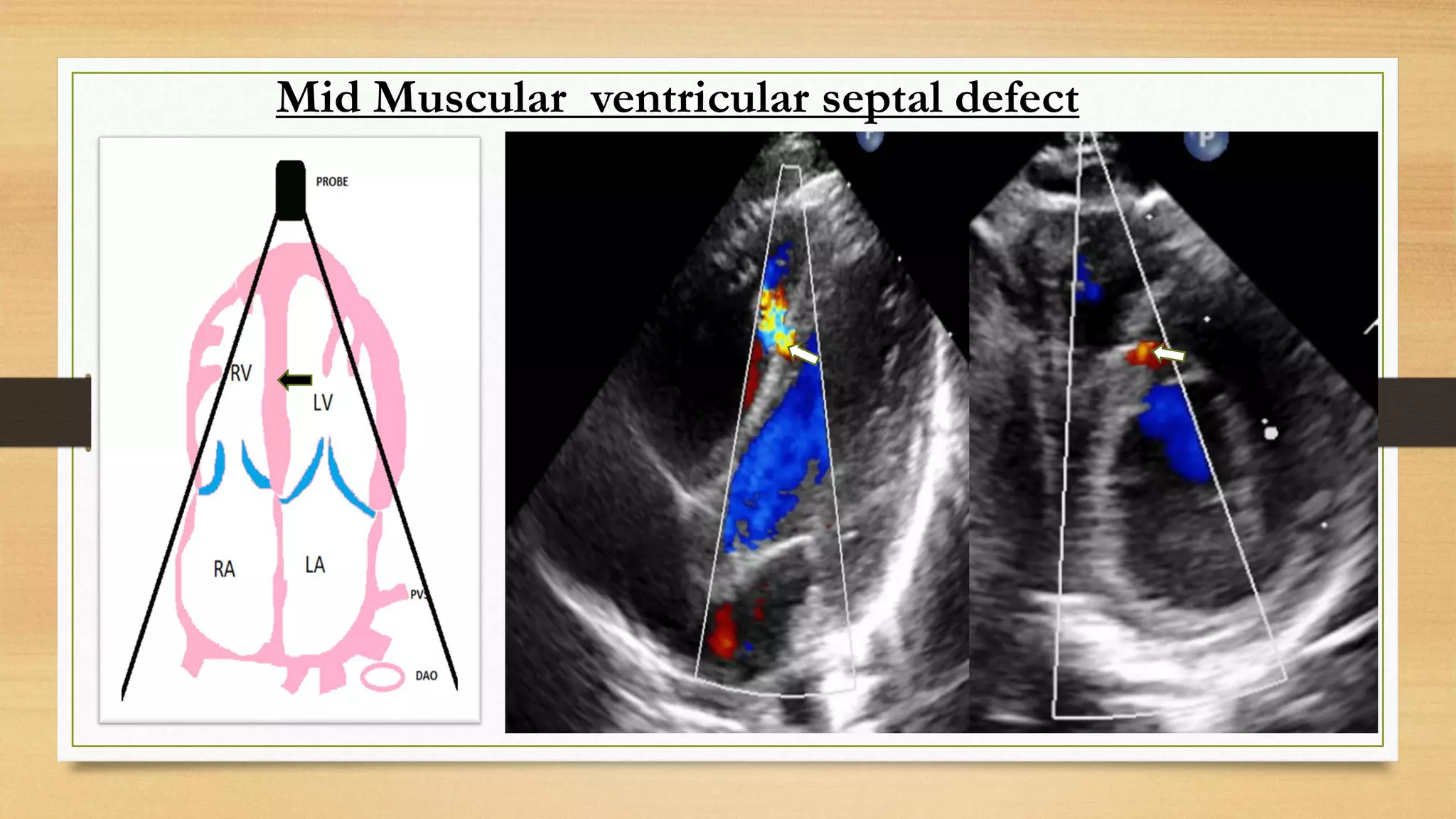 Mid Muscular ventricular septal defect
 
