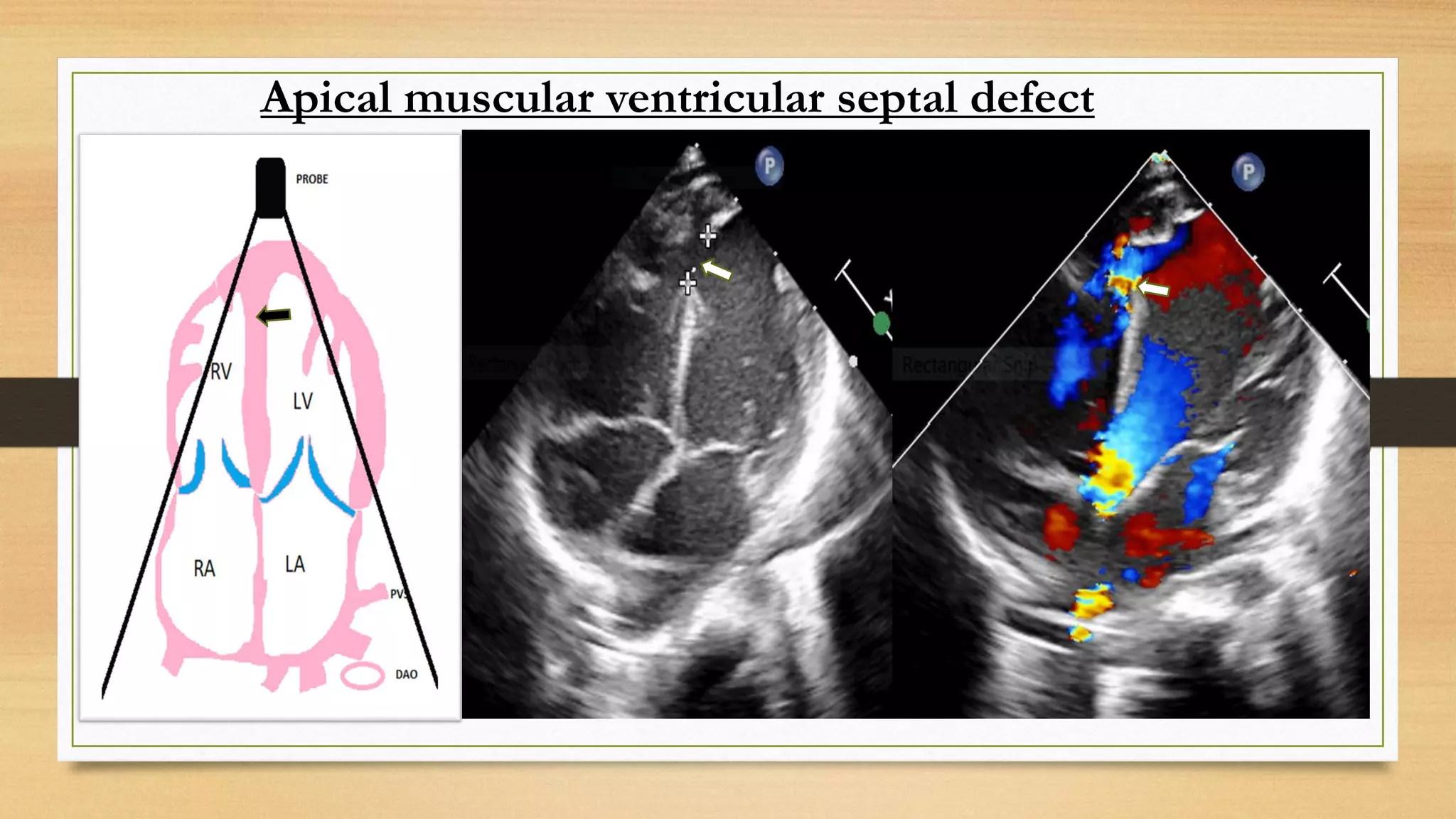 Apical muscular ventricular septal defect
iv. Muscular: 5%–20%
Apical
 
