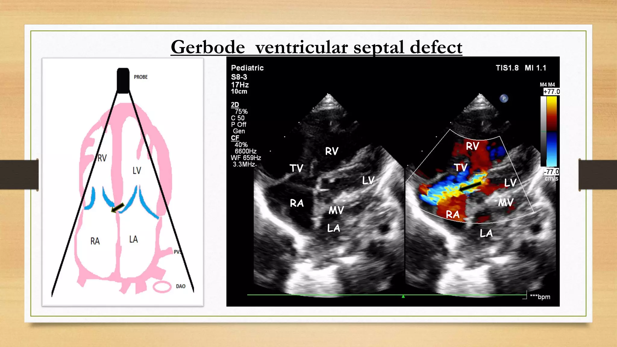 Gerbode ventricular septal defect
iii. Inlet: 5%–8%
RV RV
LV LV
LA
LA
RA
RA
TV
TV
MV
MV
 