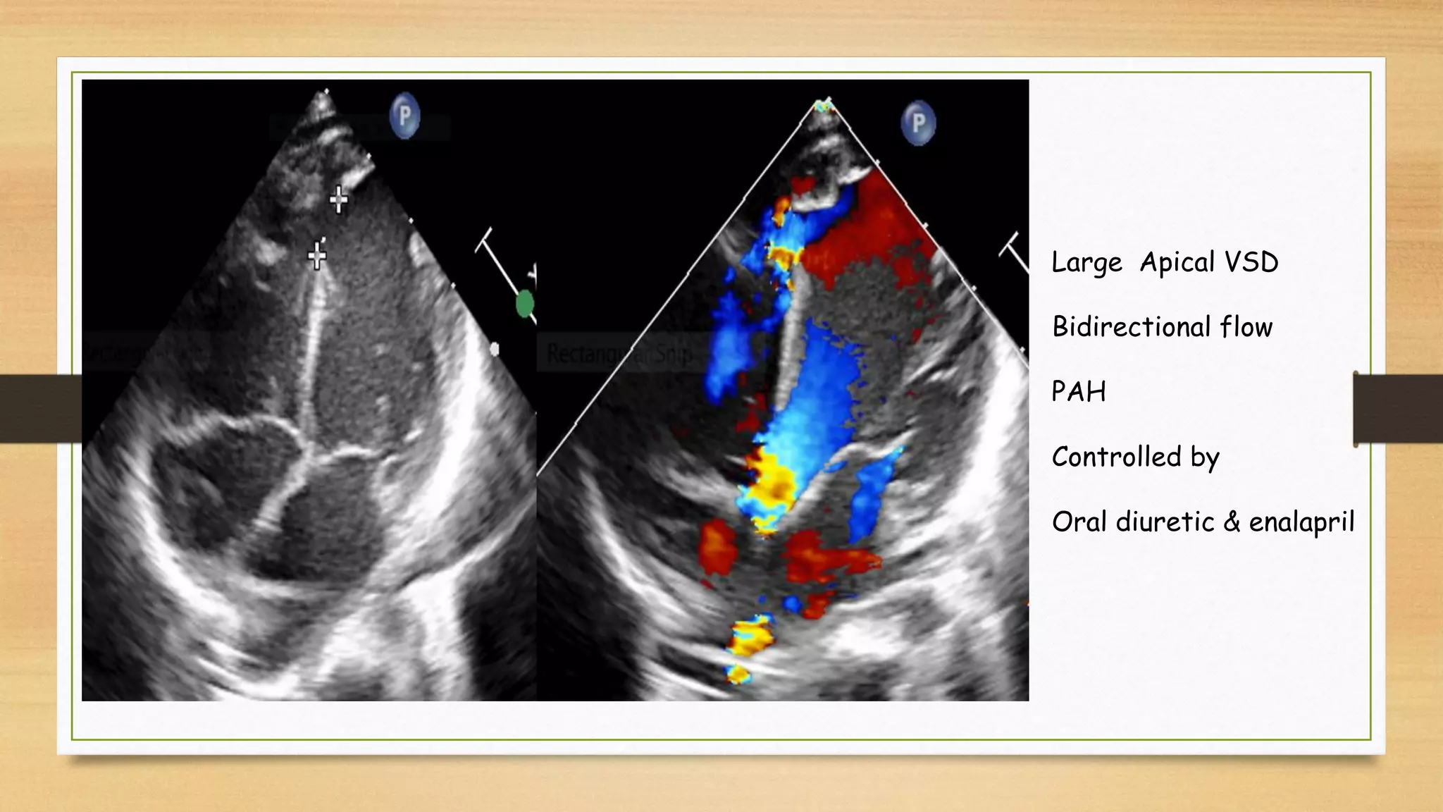 Large Apical VSD
Bidirectional flow
PAH
Controlled by
Oral diuretic & enalapril
 