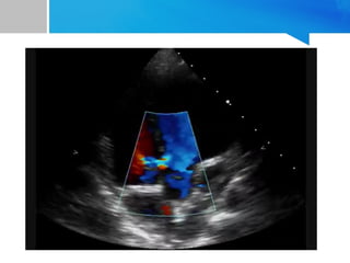 VSD_Pediatric_Cardiology and paeds residents | PPTX