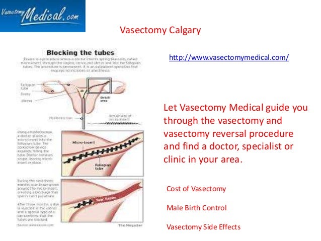 Vasectomy Cost
