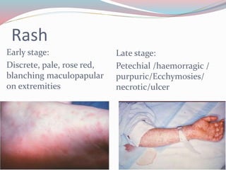 Rash 
Early stage: 
Discrete, pale, rose red, 
blanching maculopapular 
on extremities 
Late stage: 
Petechial /haemorragic / 
purpuric/Ecchymosies/ 
necrotic/ulcer 
 