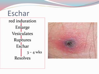 Eschar 
red induration 
Enlarge 
Vesiculates 
Ruptures 
Eschar 
3 – 4 wks 
Resolves 
 