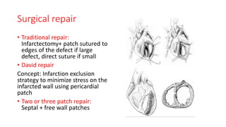 Surgical repair
• Traditional repair:
Infarctectomy+ patch sutured to
edges of the defect if large
defect, direct suture if small
• David repair
Concept: Infarction exclusion
strategy to minimize stress on the
infarcted wall using pericardial
patch
• Two or three patch repair:
Septal + free wall patches
 