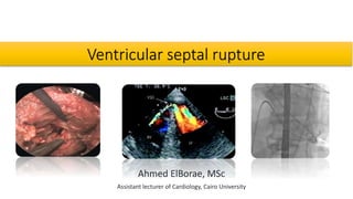 Ventricular septal rupture
Ahmed ElBorae, MSc
Assistant lecturer of Cardiology, Cairo University
 