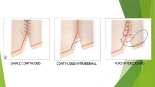 Intradermal Pattern Comprehensive Guide to Suture Patterns and Surgical Knots in Veterinary ...
