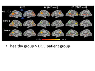 • healthy group > DOC patient group
 