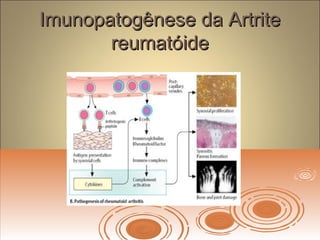 Imunopatogênese da ArtriteImunopatogênese da Artrite
reumatóidereumatóide
 