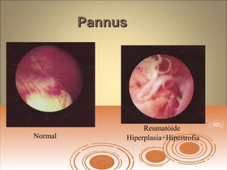PannusPannus
Normal
Reumatóide
Hiperplasia+Hipertrofia
 